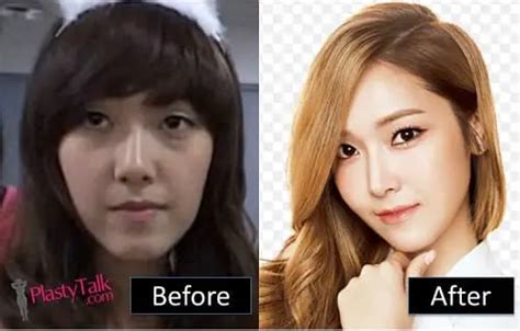 Taeyeon Plastic Surgery Before After