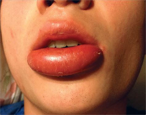 Lip Abscess Associated With Isotretinoin Treatment Acne Jama
