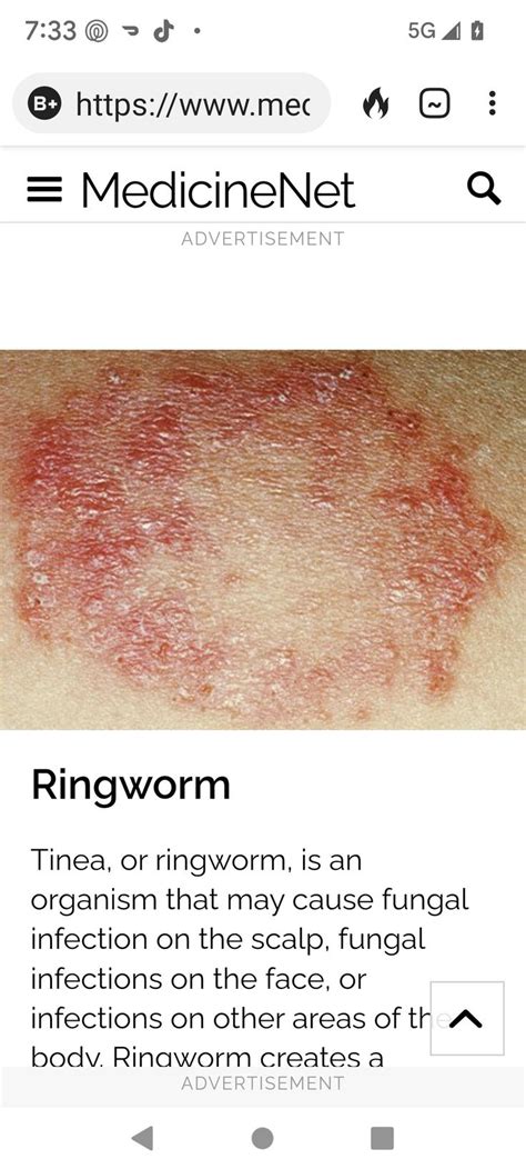 Pin By Cheri Angel On Parasites In 2022 Fungal Infection Ringworm