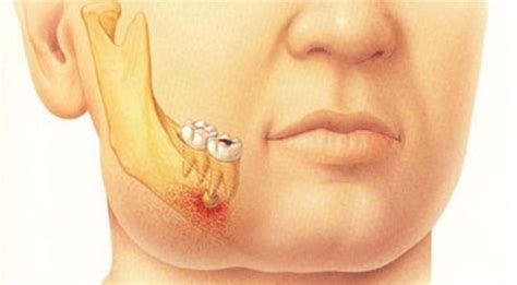 Petua dan cara merawat membuang batu karang dalam hempedu menggunakan kaedah rawatan berikutnya adalah petua yang dikongsikan dan sekiranya anda ingin penyakit batu dalam hempedu kulit serta mata putih nampak kekuningan. Tips Dan Petua Hilangkan Sakit Gigi Tanpa Guna Ubat (6 Petua)