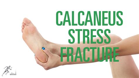 Calcaneus Stress Fracture Signs Symptoms And Treatment