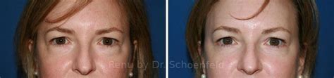 Blepharoplasty Photos Chevy Chase Md Patient 7251