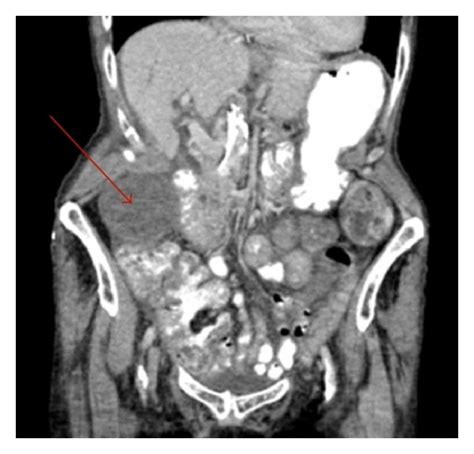 Ct Scan Abdomen And Pelvis Image Showing A Large “fluid Collection” In