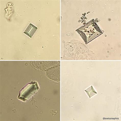 Triple Phosphate Crystals Bright Field X400 Urinarysediment Urine