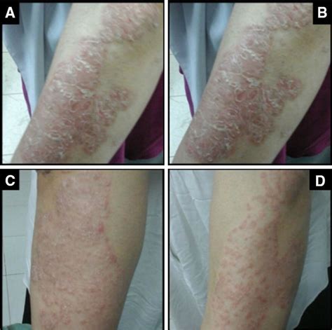 Plaque Psoriasis Of The Arm Before And After Treatment Download