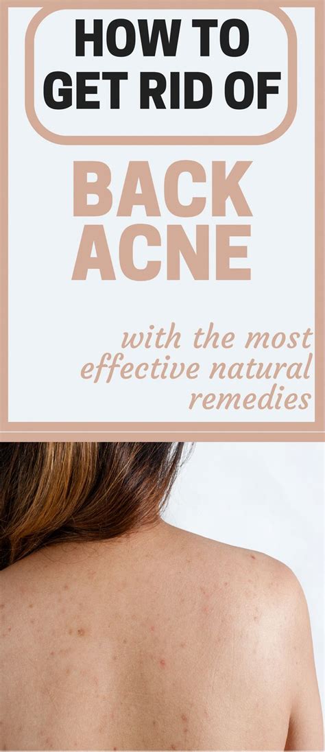 17 Natural Remedies On How To Get Rid Of Back Acne In 2020 Diy Acne