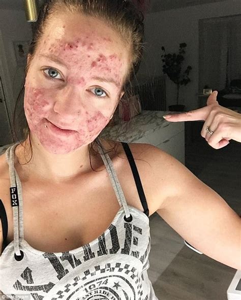 Manitoba Woman Shares Her Battle Against Severe Acne Daily Mail Online