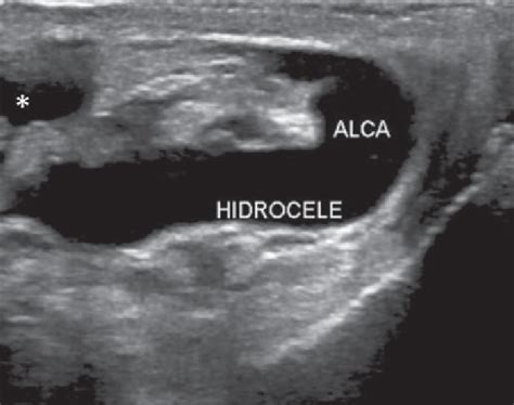 Inguinal Hernia Associated With Hydrocele B Mode Us Showing An