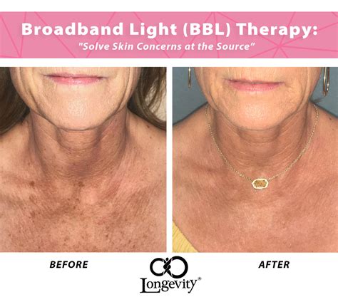 Broadband Light Therapy Reduce Hyperpigmentation And Acne In Okc