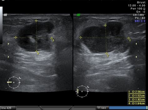 Am oberen gebärmutterende, dem fundus uteri, befinden sich zwei seitliche ausläufer, die eileiter. Brustultraschall / Vaginalultraschall | Dr. med. M. Bulgay ...