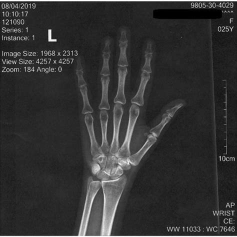 Single X Ray Radiograph Of The Left Wrist Hand And Fingers Bone Age