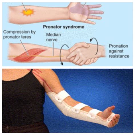 Relieving Pronator Syndrome Effective Exercises And Splinting Techniques