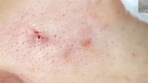 Huge Blackhead Extraction Acne Ance Deep Blackheads Removal Youtube