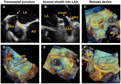 Role Of Real Time‑three Dimensional Transesophageal Echocardiography In