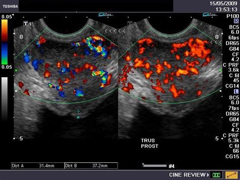 A Gallery Of High Resolution Ultrasound Color Doppler And 3d Images Prostate