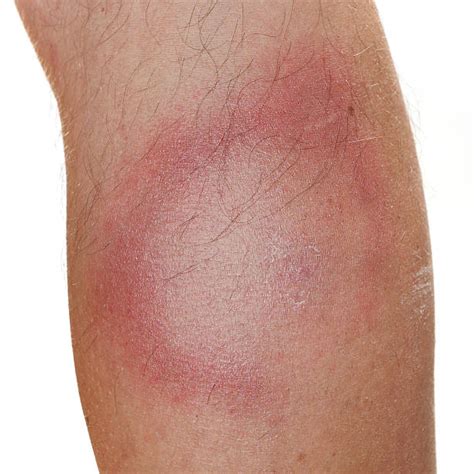Erythema Migrans Stock Photos Pictures And Royalty Free Images Istock