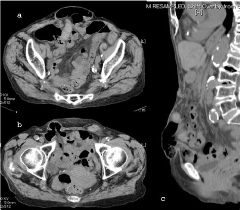 Preoperative Abdominal Ct Scan A Large Incisional Hernia In The