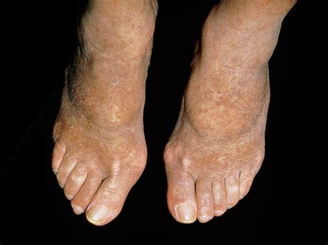 Peripheral Arterial Disease Of A Womans Feet Photograph By Dr Hc