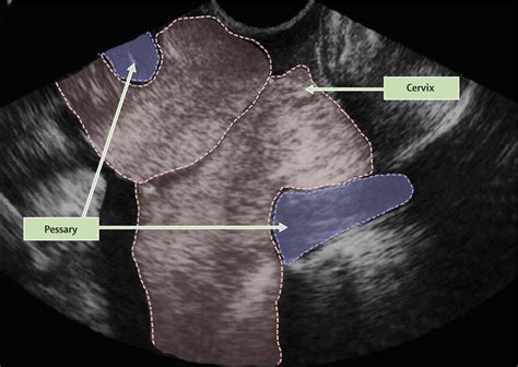 Supplemental Materials For Cervical Pessary In Pregnant Women With A Short Cervix Pecep An