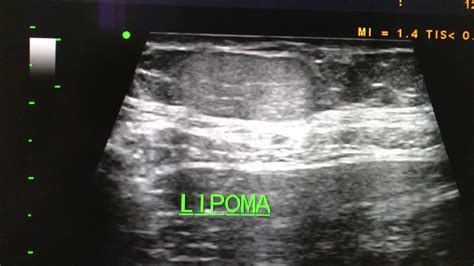 Lipoma Ultrasound Youtube