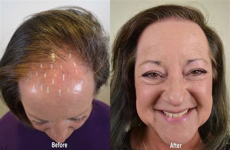 Happy Hairline Restoration Hair Restoration Of The South