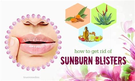 Just be careful to be sterile when you. 17 Tips On How To Get Rid Of Sunburn Blisters On Nose ...