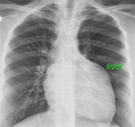 X Ray Chest PA View In Heart Failure All About Cardiovascular System