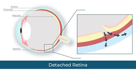 Retinal Detachment Surgery In Arizona — Diagnosis And Treatment