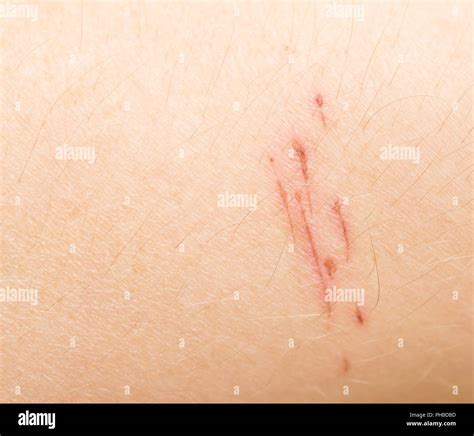 Scrape Skin Hi Res Stock Photography And Images Alamy