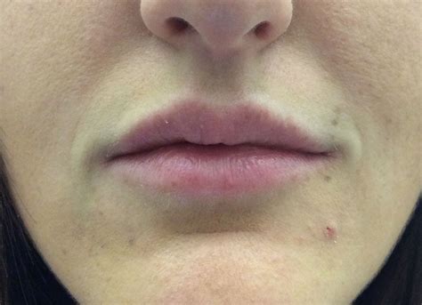 Temporary Lip Fillers Overview Cost Recovery Before And After Aedit