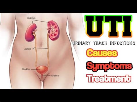 Uti Urinary Tract Infection Causes Symptoms Complications And Management Urdu Hindi Uti