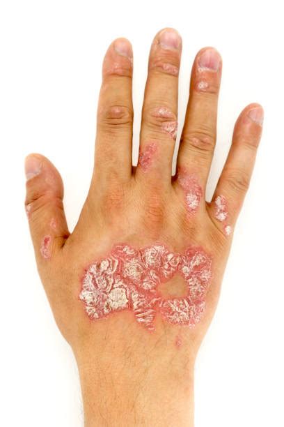 Pustular Psoriasis Photos Stock Photos Pictures And Royalty Free Images