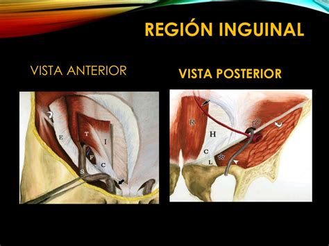 Hernia Inguinal Imagenologia