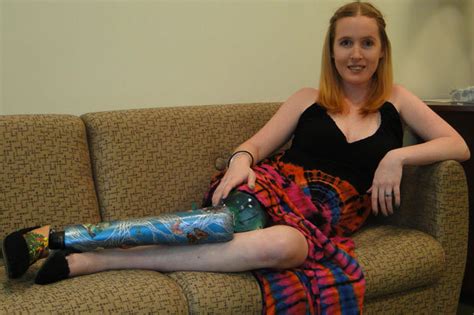 Farewell Bone Cancer Survivor Holds A Party For Her Leg Before It Was