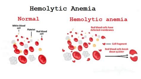 Hemolytic Anemias Has