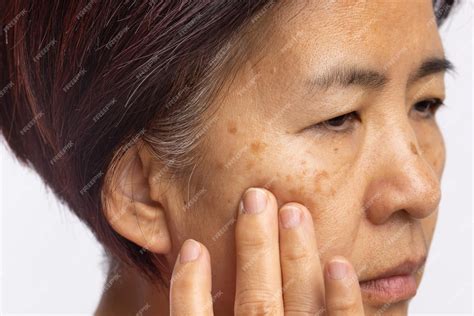 Premium Photo Menopausal Women Worry About Melasma On Face