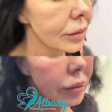 Fotona 4d Laser Facelift Cost Procedure Results And Side Effects