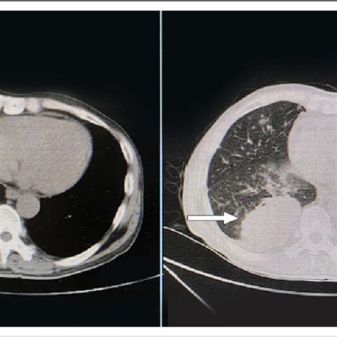 Lung Computed Tomography Showing A Soft Tissue Mass Shadow In The