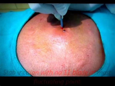 Huge Infected Sebaceous Cyst Back Drainage Youtube