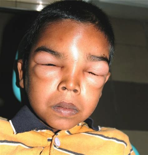 A 7 Year Old Boy Exhibiting Diffuse Facial Swelling Involving Forehead