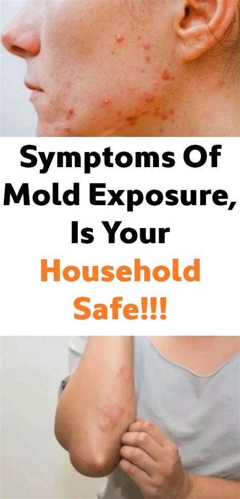 Symptoms Of Mold Exposure Is Your Household Safe Mold Exposure Symptoms Of Mold Black