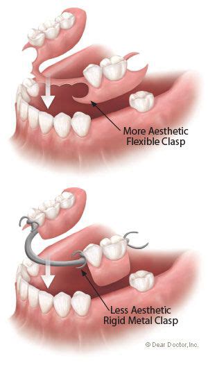 bio functional prosthetic system bps dentures fixing elite dental care tracy elite dental care