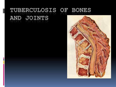 Pdf Tuberculosis Of Bones And Joints File