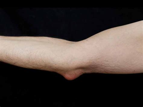 Health Qanda Swollen Elbow Olecranon Bursitis Bursitis Treatment