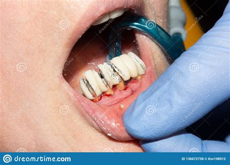 Dental Restoration Of Rotten Roots Of The Teeth With Ceramic Crowns Cast Posts Dentistry Stock