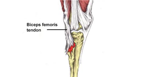 Biceps Femoris Tendon Avulsion