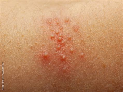 Foto De Close Up Of Girl Has Rash And Other Nonspecific Skin Eruption