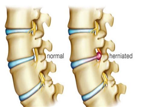 It may be tender to touch and feel like the muscles are in spasm too. Herniated Disc | Poughkeepsie, NY: