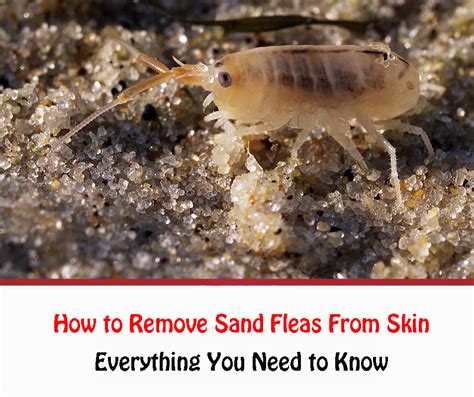 How To Remove Sand Fleas From Skin