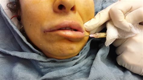 Lip Enlargement With Fat Injection Youtube